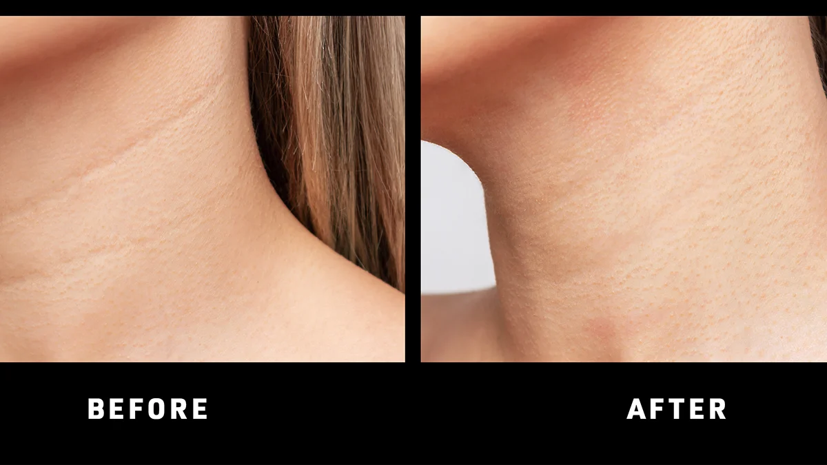 FAQ 211 red light therapy before and after real
