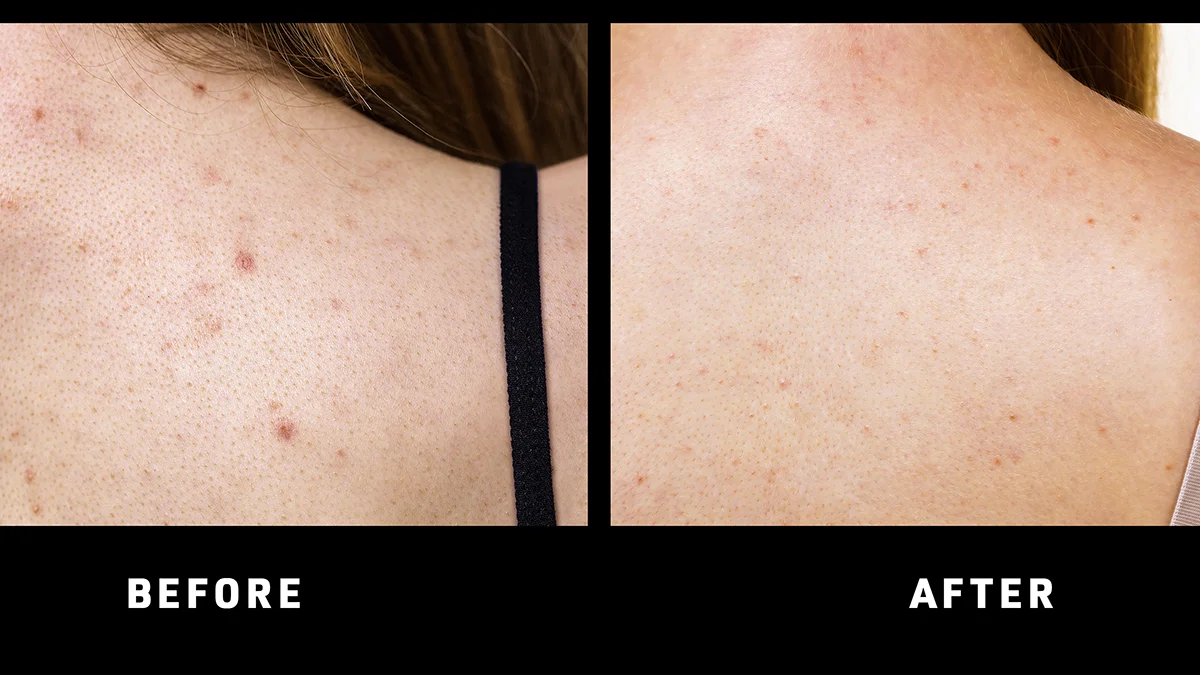 FAQ 211 red light therapy before and after back acne