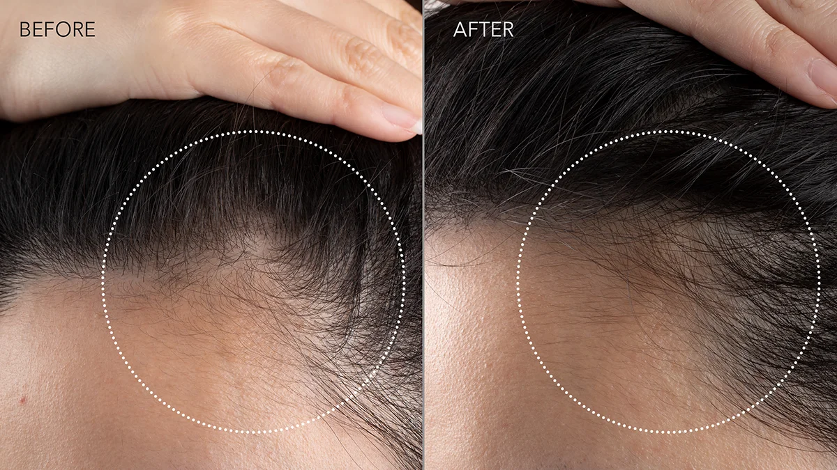 FAQ 301 red light therapy before and after hair growth