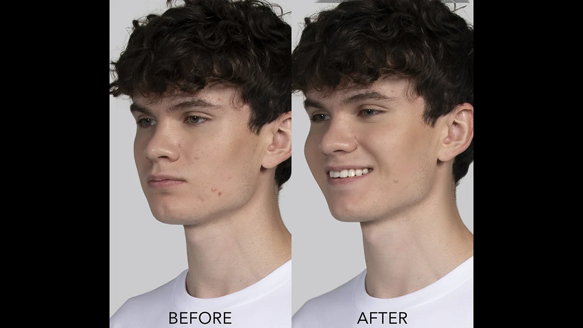 acne blue light therapy before and after on a teenage boy with significant skin improvement
