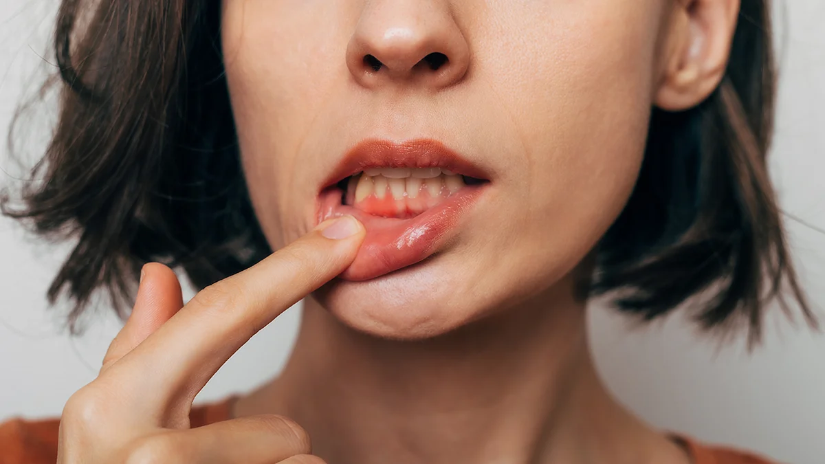 A woman showing her inflammed gums