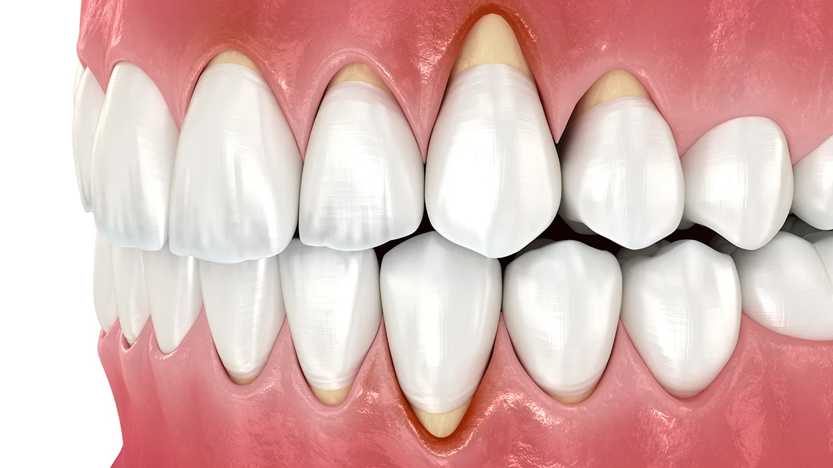 A vector image of teeth with obvious gum recession