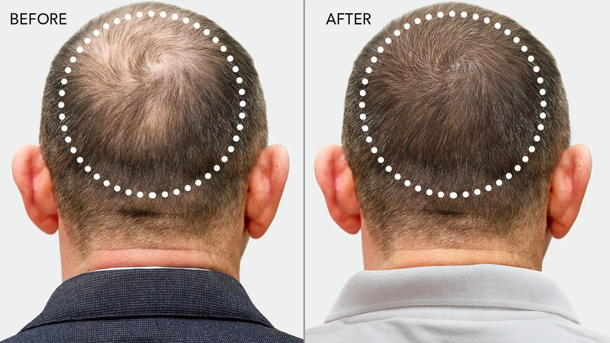 FAQ 302 Before & After results back of a man's head