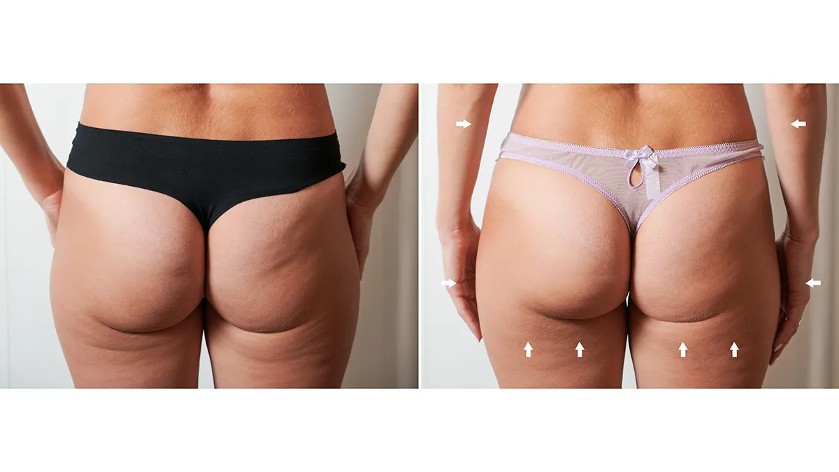 FAQ 411 before and after microcurrent results on thighs and buttocks