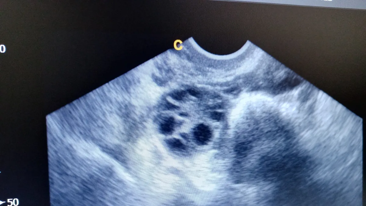 polycystic ovary syndrome ultrasound photo