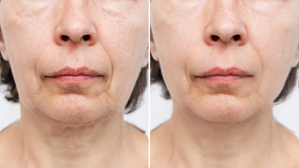 FAQ 402 before and after 