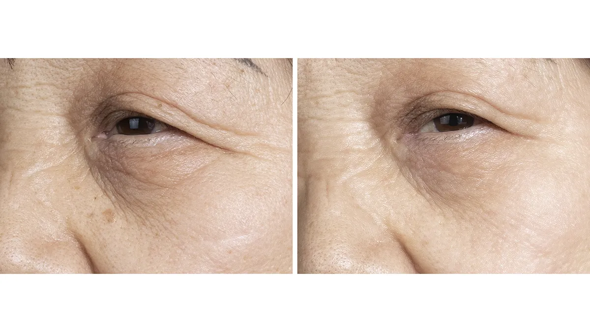 FAQ 402 before and after