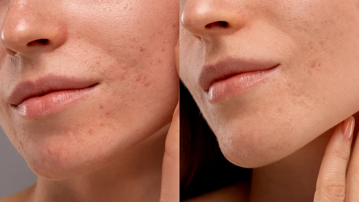 FAQ red light panel before after