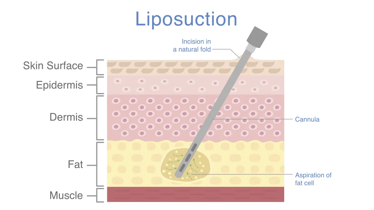 liposuction