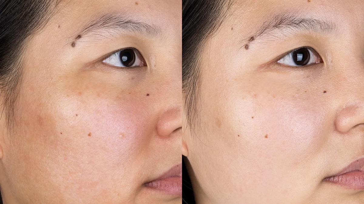 UFO LED Lighthouse Panel light therapy lamp before after