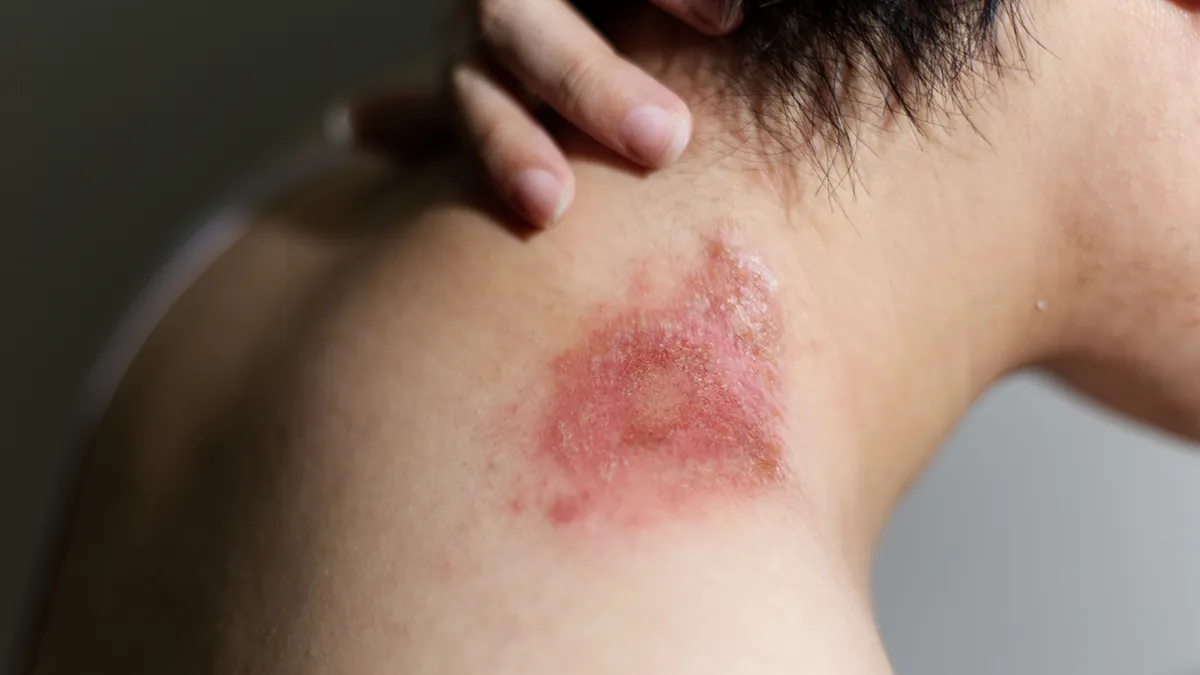 skin problems, rash, excema