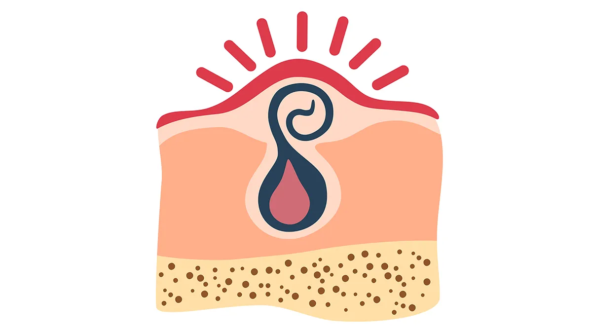 A cartoon depiction of a coiled ingrown hair