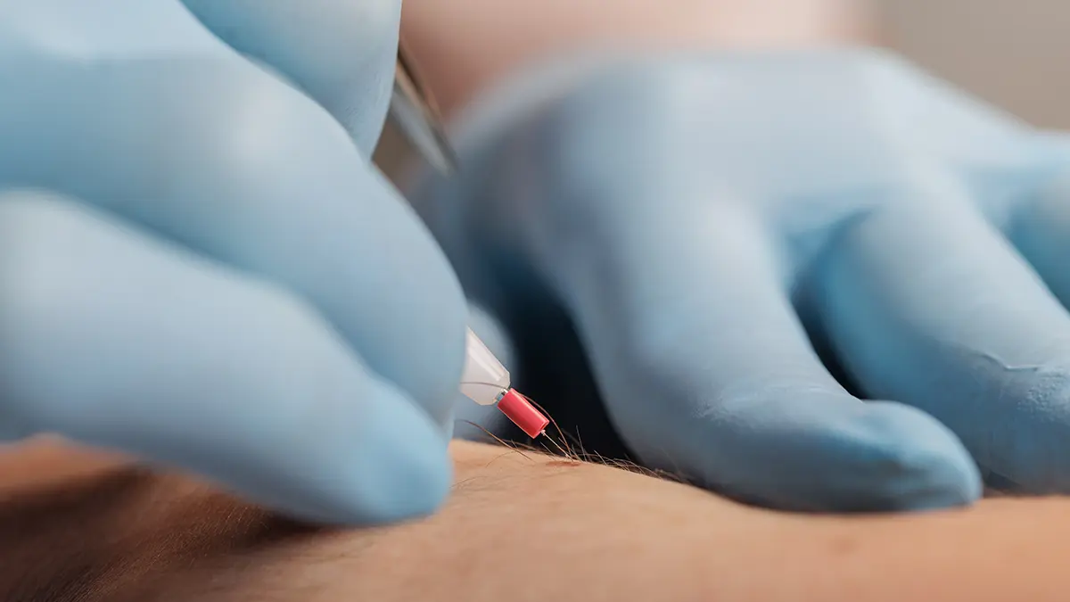 electrolysis done in sky blue gloves