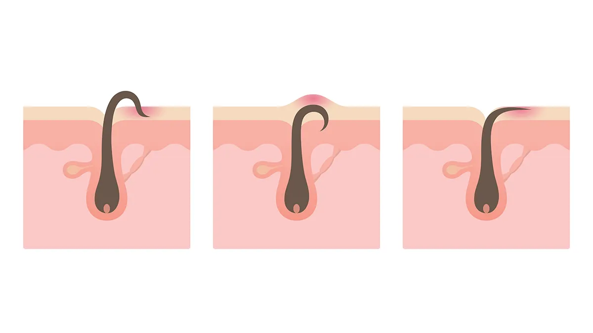 Different types of ingrown hairs