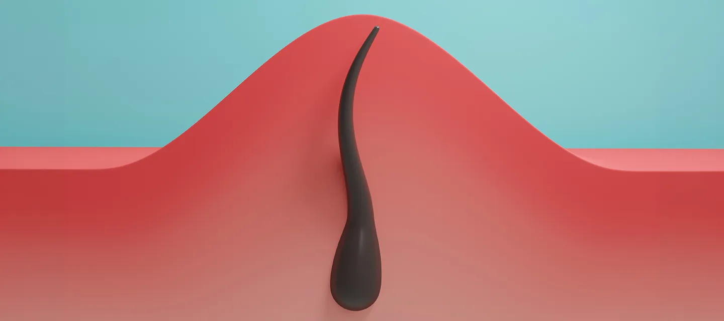 Ingrown hair