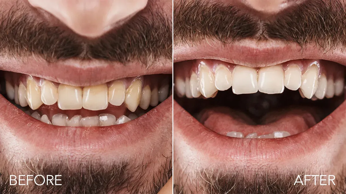 Closeup of a bearded man's mouth issa Teeth Whitening Set before & after results