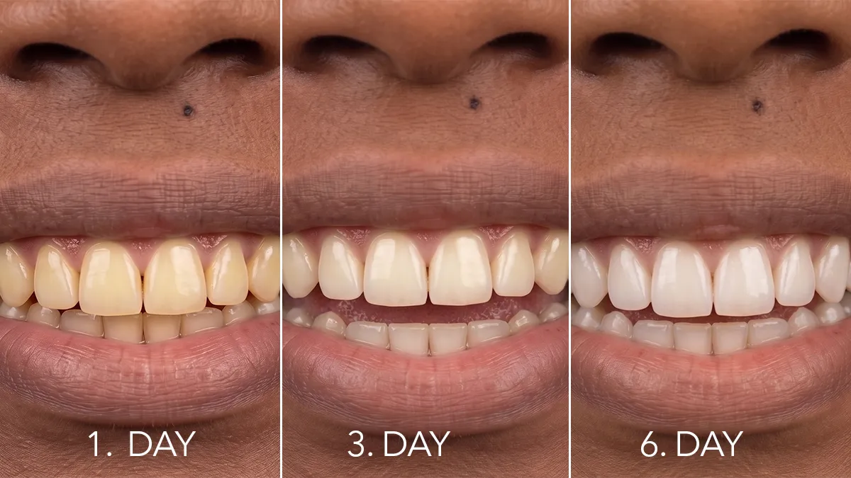Closeup of a woman's mouth issa Teeth Whitening Set before & after results