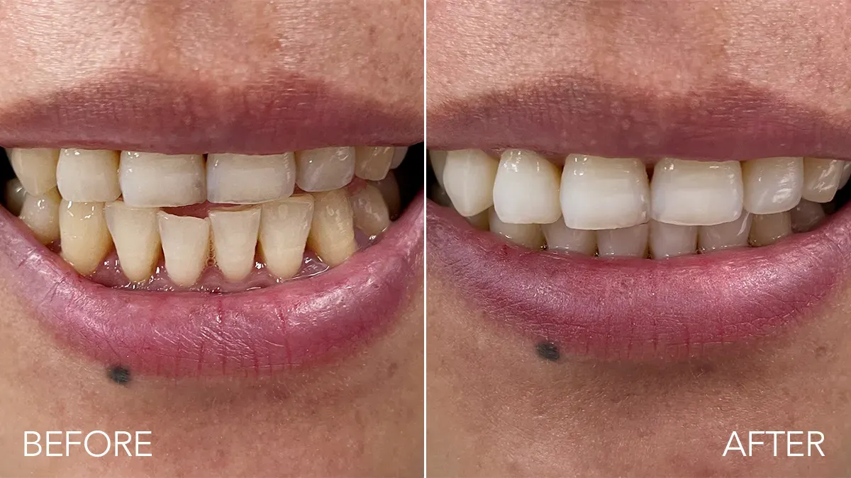 Closeup of a woman's mouth issa Teeth Whitening Set before & after results