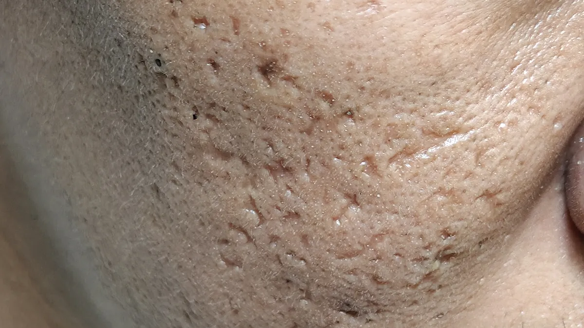 Closeup of deep acne scars
