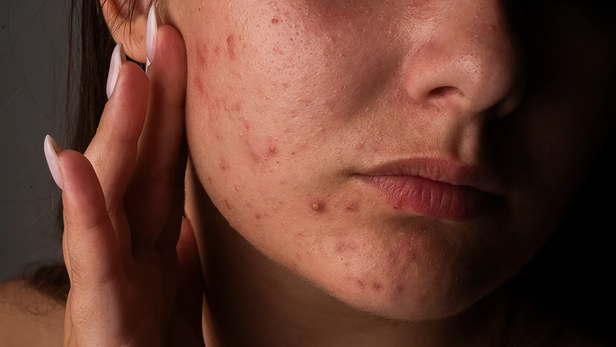 A woman with bad skin wondering does red light therapy help with acne