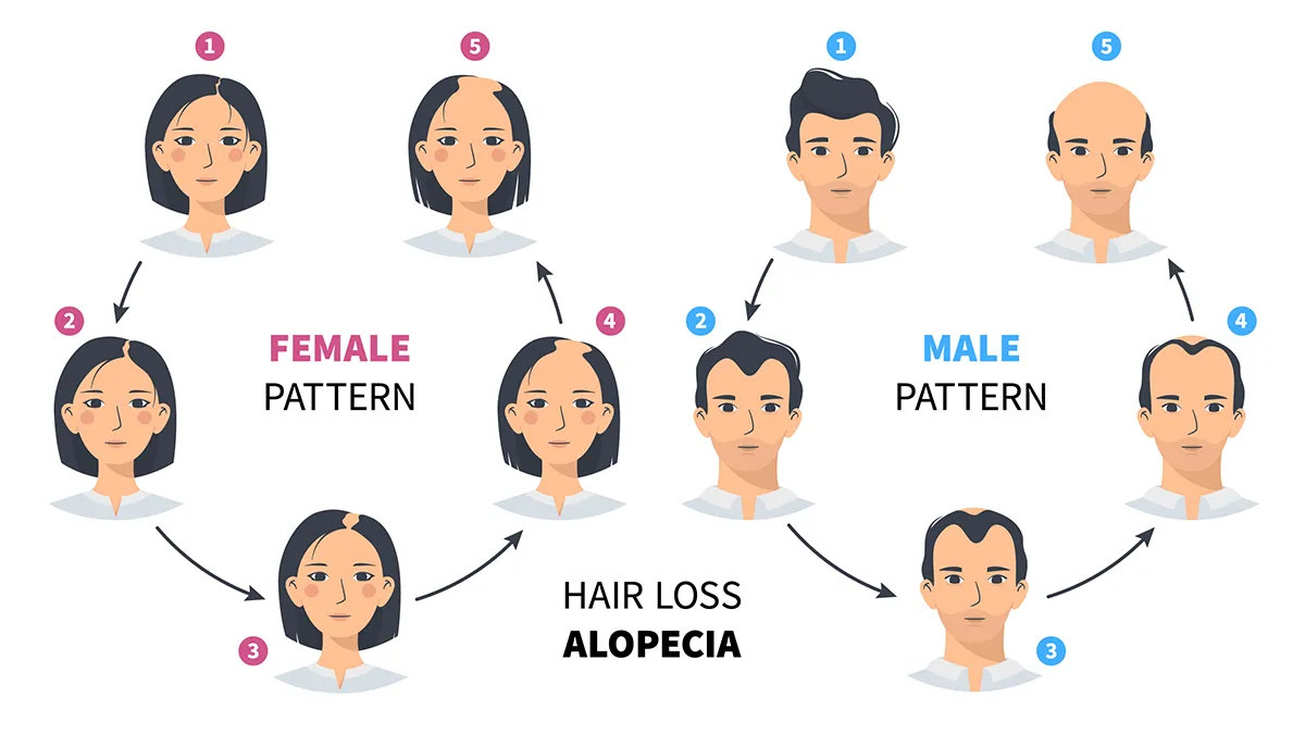 male and female hair loss