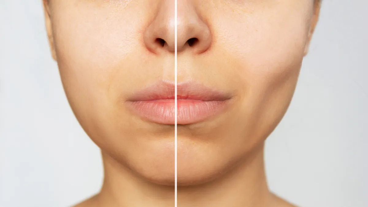 ozempic face before and after