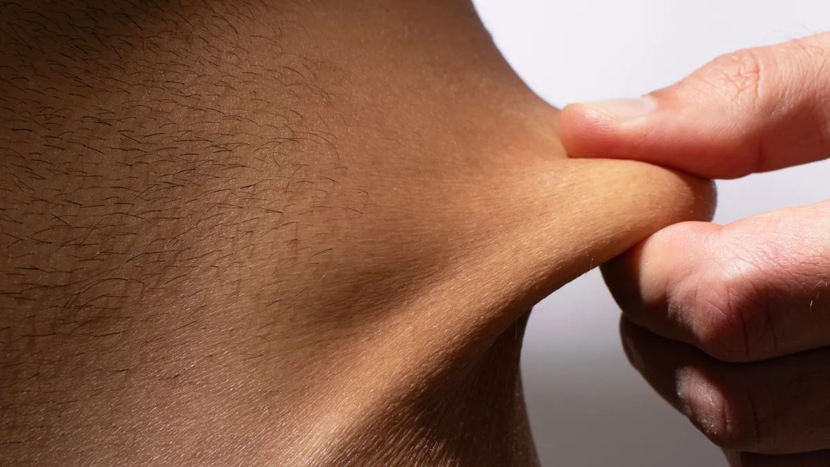 A person pulling on the loose skin on their body