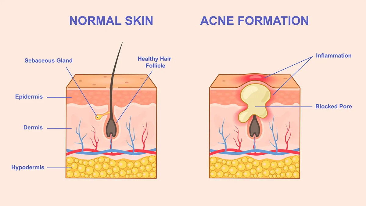 A diagram showing a crossection of acne and healthy skin