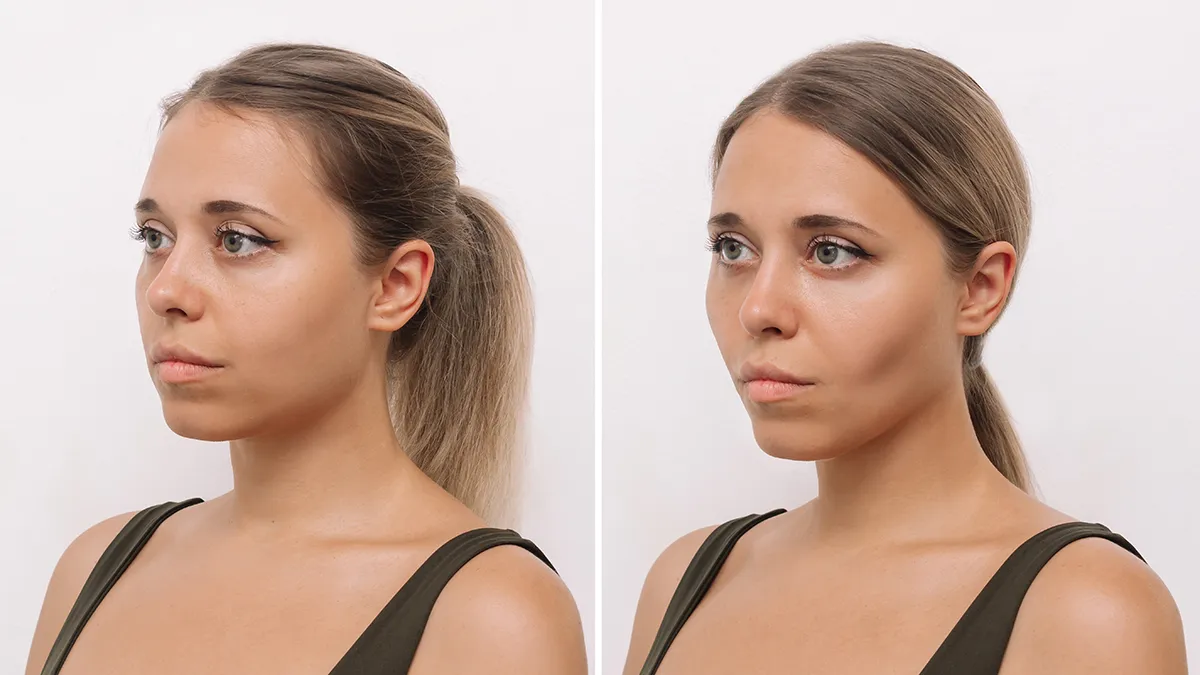 A woman before and after ozempic