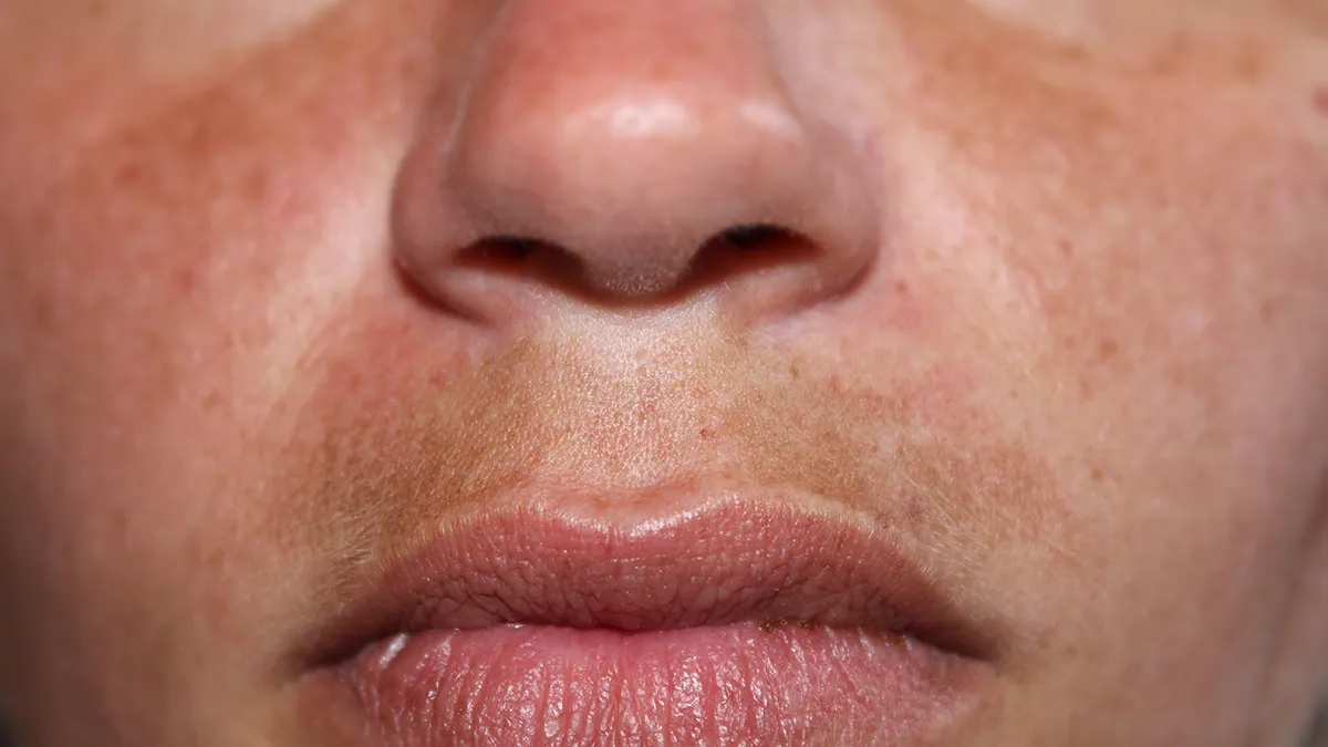 A woman with pregnancy melasma on her face