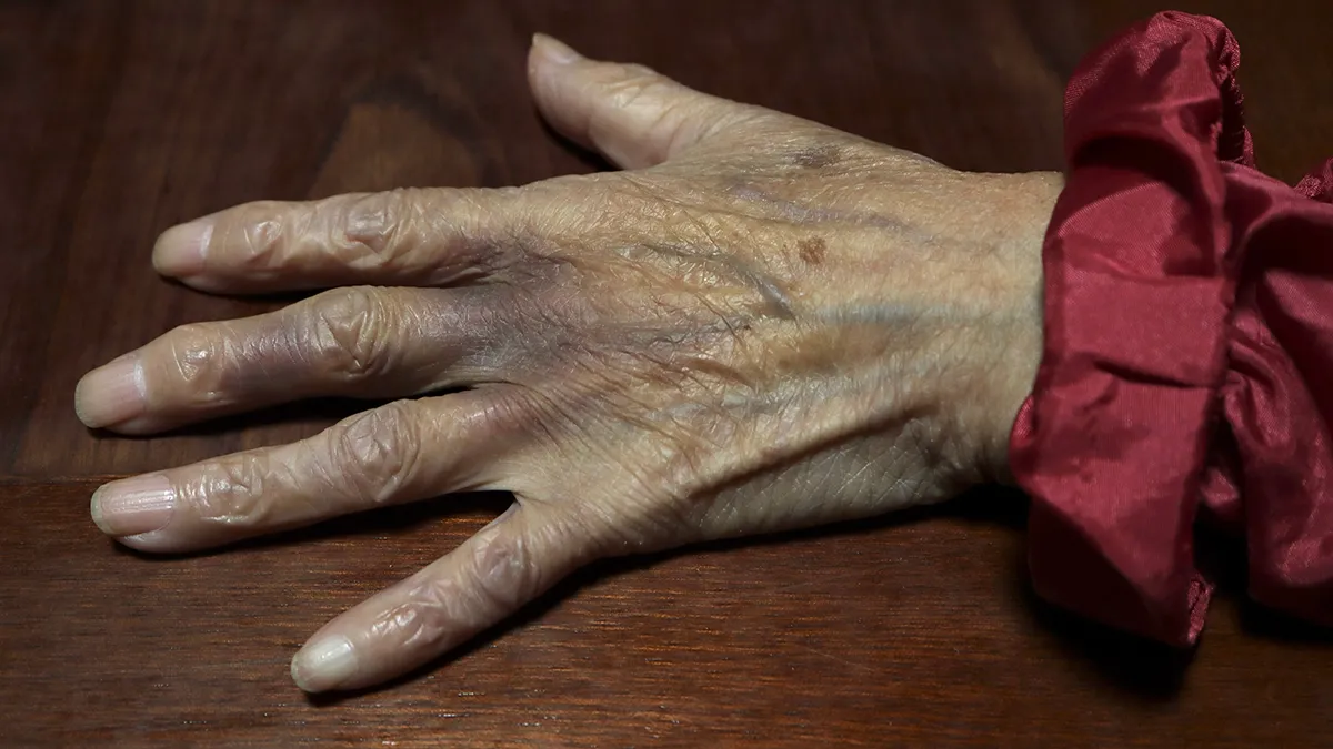 sun spots age spots liver spots on an old woman's hand