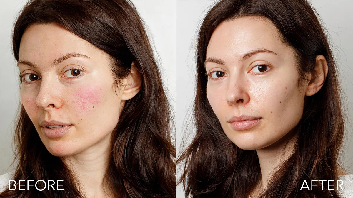 red light therapy panel and red light serum before and after