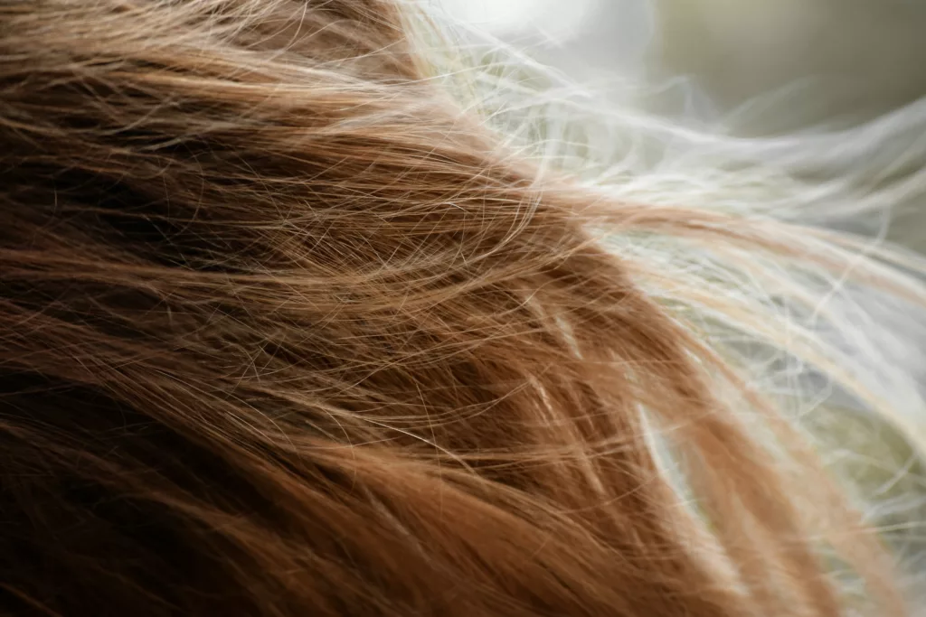 alopecia