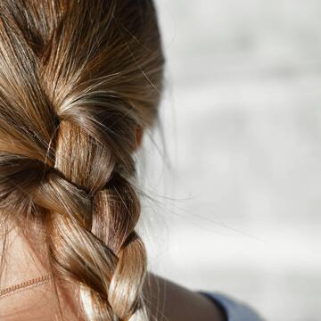 alopecia