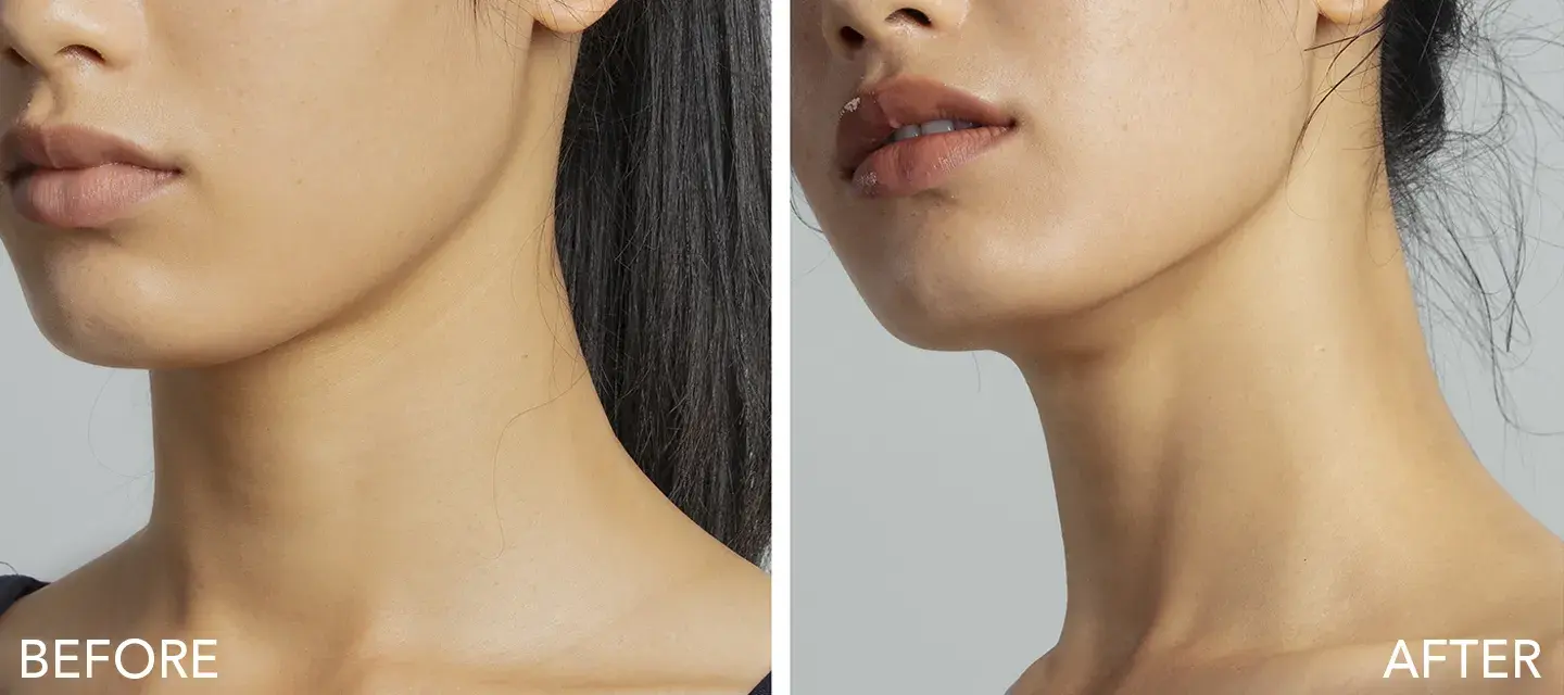 Does microcurrent work A woman's jawline before and after microcurrent showing if microcurrent works