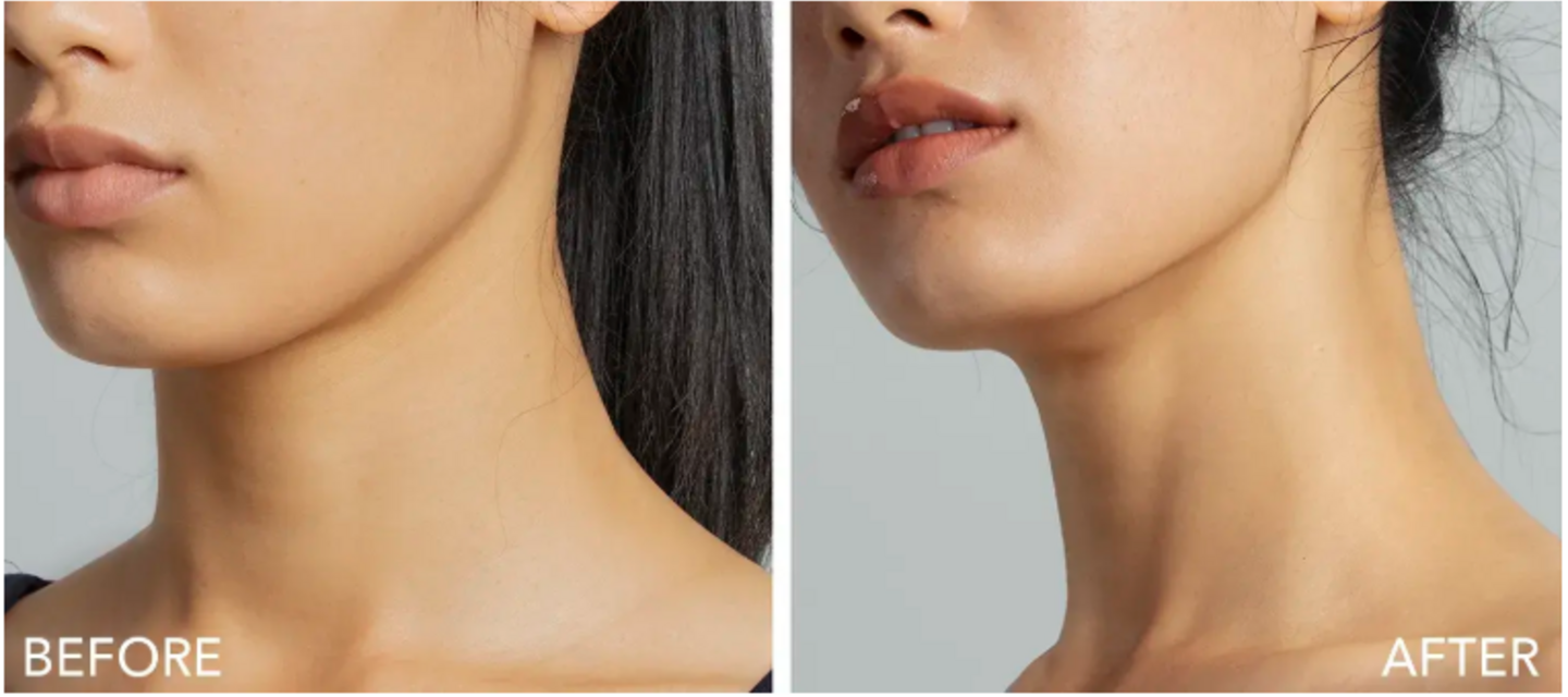 microcorrientes lifting facial