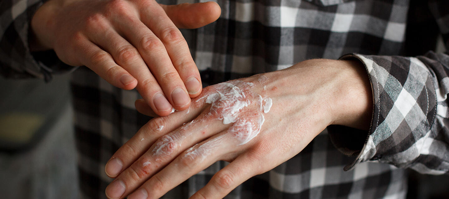 psoriasis