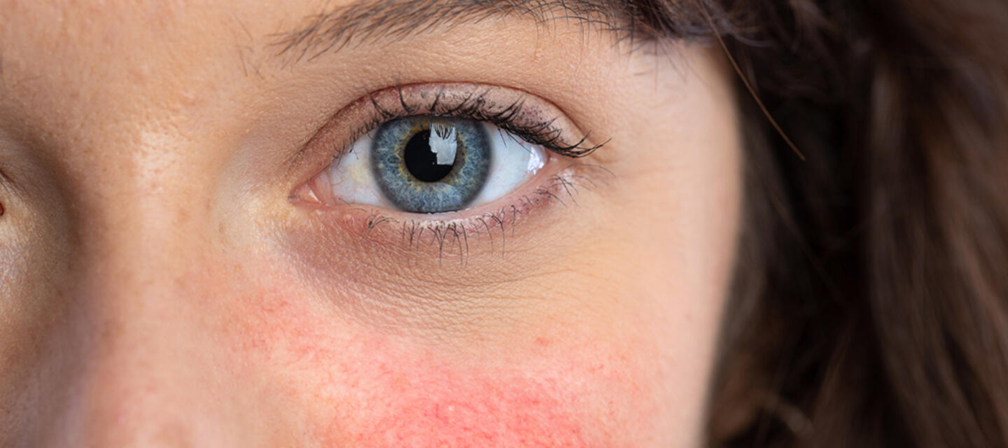 rosacea