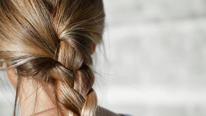 alopecia alopecia