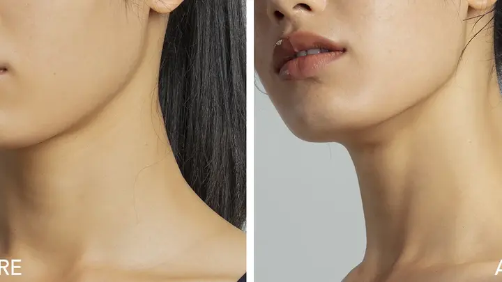Does microcurrent work A woman's jawline before and after microcurrent showing if microcurrent works