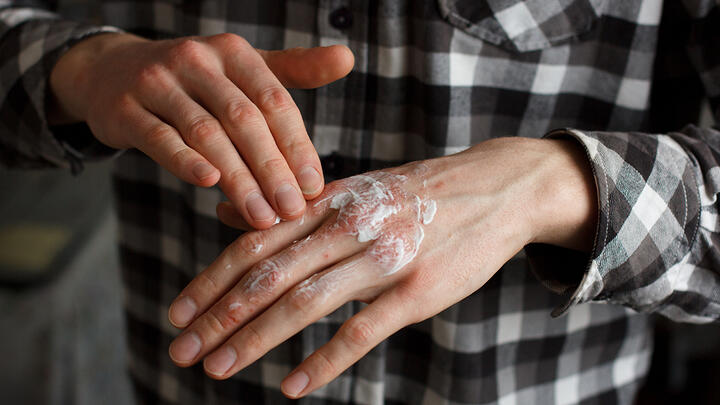 psoriasis
