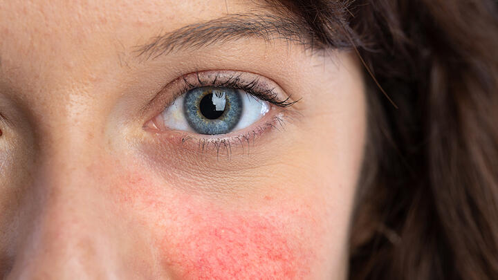 rosacea